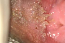 il papilloma virus passa da solo îndepărtați limba condilomului